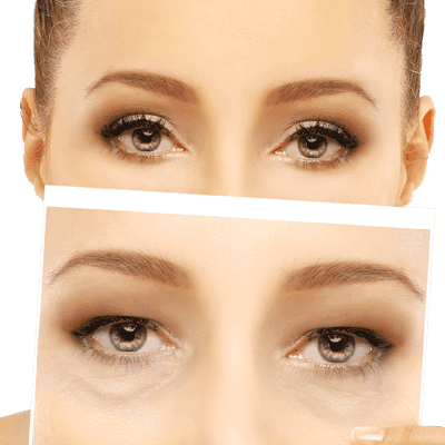 Blepharoplasty
