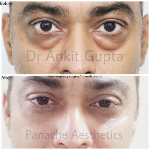 Blepharoplasty before after panache aesthetics 8 Blepharoplasty before after panache aesthetics