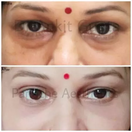 Blepharoplasty surgery in delhi 4 under eye bags