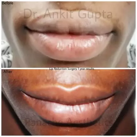 Lip reduction before after Lip reduction surgery delhi