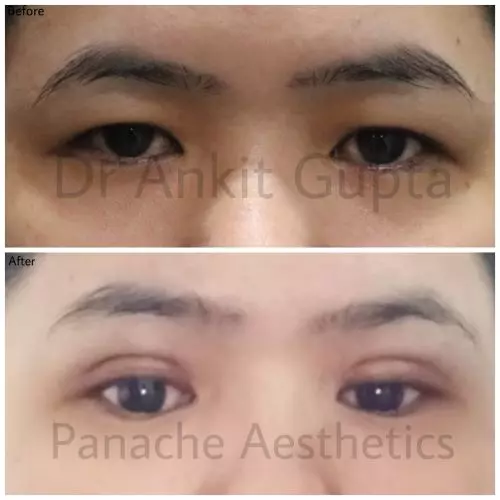 best blepharoplasty surgery in delhi