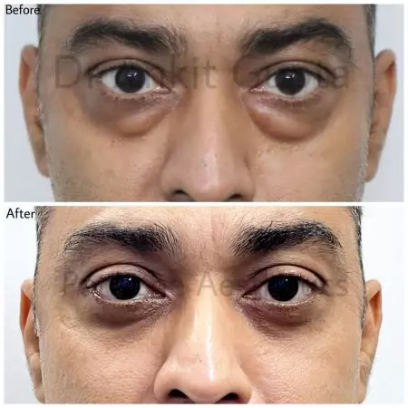 Under eye bags under eye bags