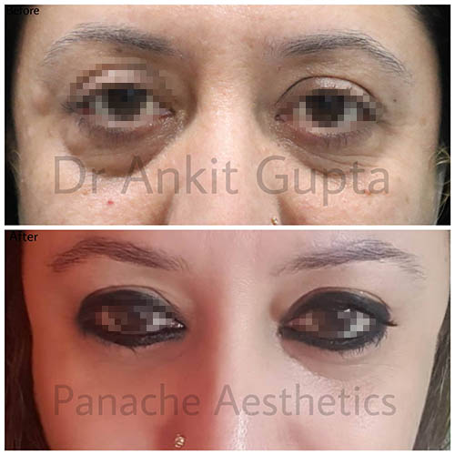 blepharoplasty under eye bags