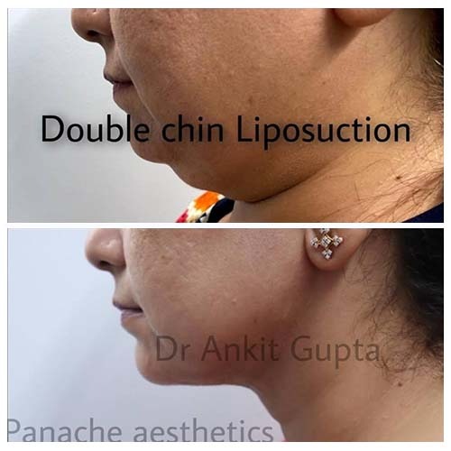 chin-liposuction-panache