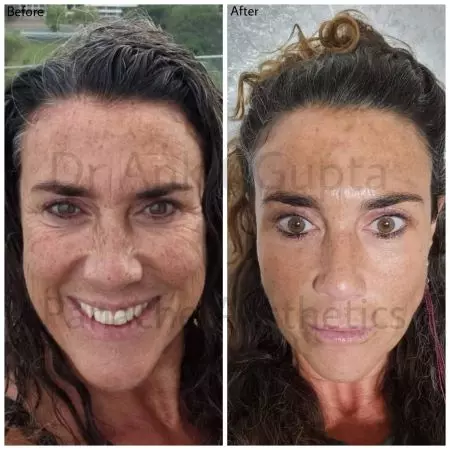 fat grafting face Liposuction in delhi