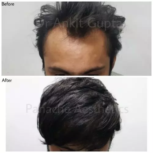 hair transplant final results